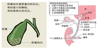 微創(chuàng)保膽取石---膽囊結(jié)石病人的福音