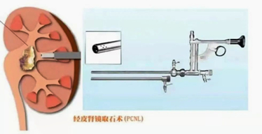 不懂經皮腎鏡是什么？軒科告訴你！