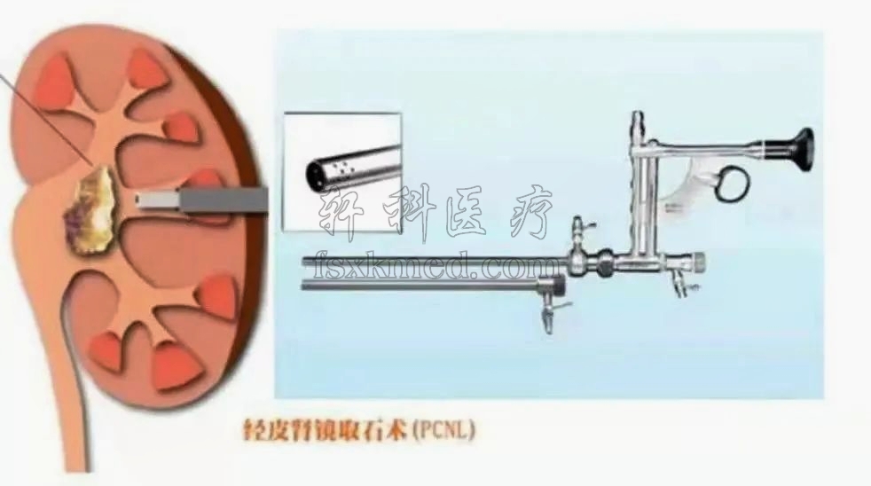 圖2-1  經皮腎鏡.jpg